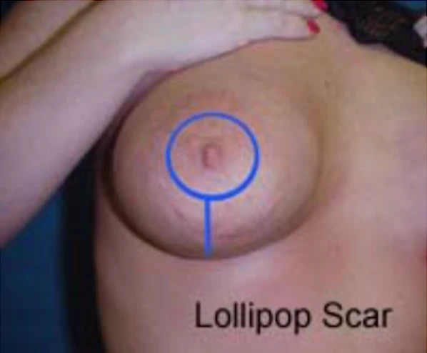 Lollipop Scar | Peninsula Plastic Surgery | MD and DE