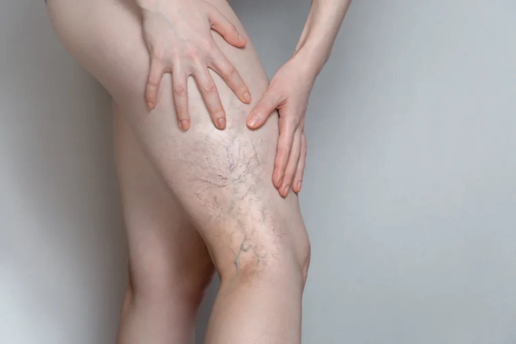 Spider Veins | Peninsula Plastic Surgery | MD and DE