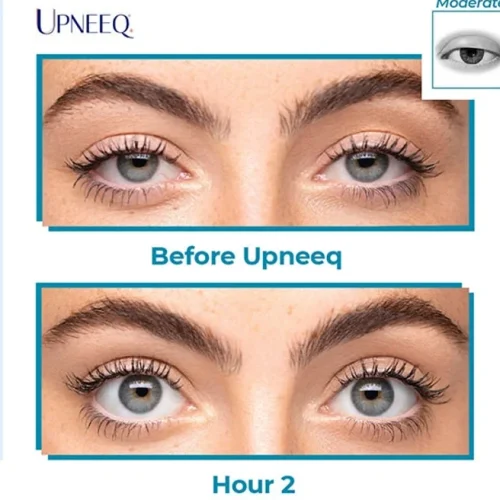 Upneeq before and after images | Peninsula Plastic Surgery | MD and DE